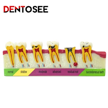 Модель кариеса зубов Классифицирует модель патологического процесса вокруг зубов Эволюция кариеса разрушена